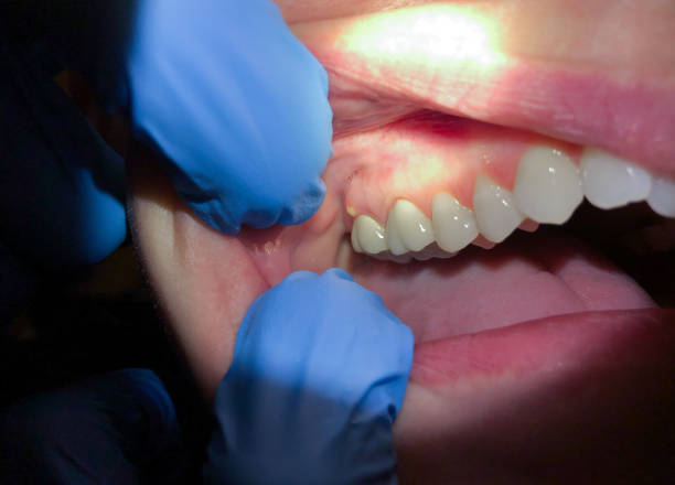 Best Emergency Dental Care for Broken or Chipped Teeth in Norwich, NY